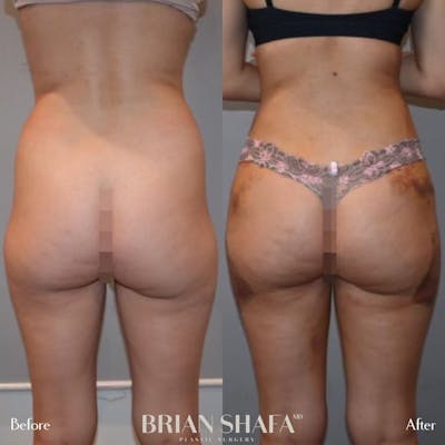 Liposuction Before & After Photos - Patient 122876289 - Image 2