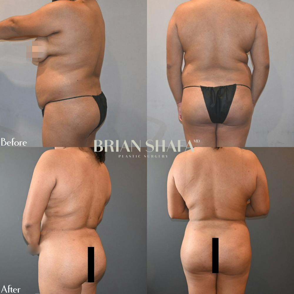 Brazilian Butt Lift Before & After Gallery - Patient 140840893 - Image 1