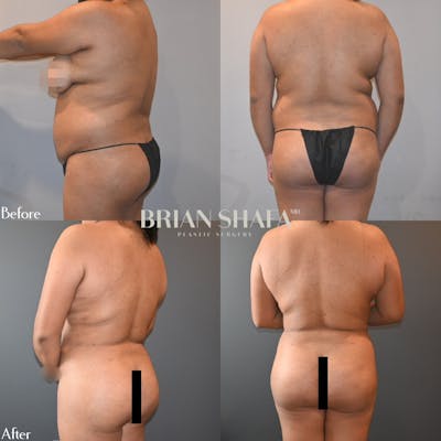 Brazilian Butt Lift Before & After Gallery - Patient 140840893 - Image 1