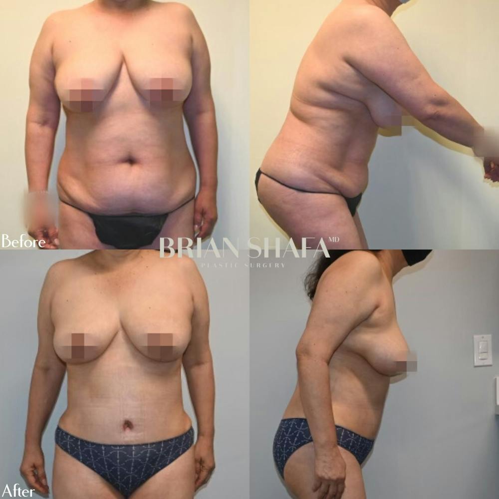 Mommy Makeover Before & After Photos - Patient 141066784 - Image 1