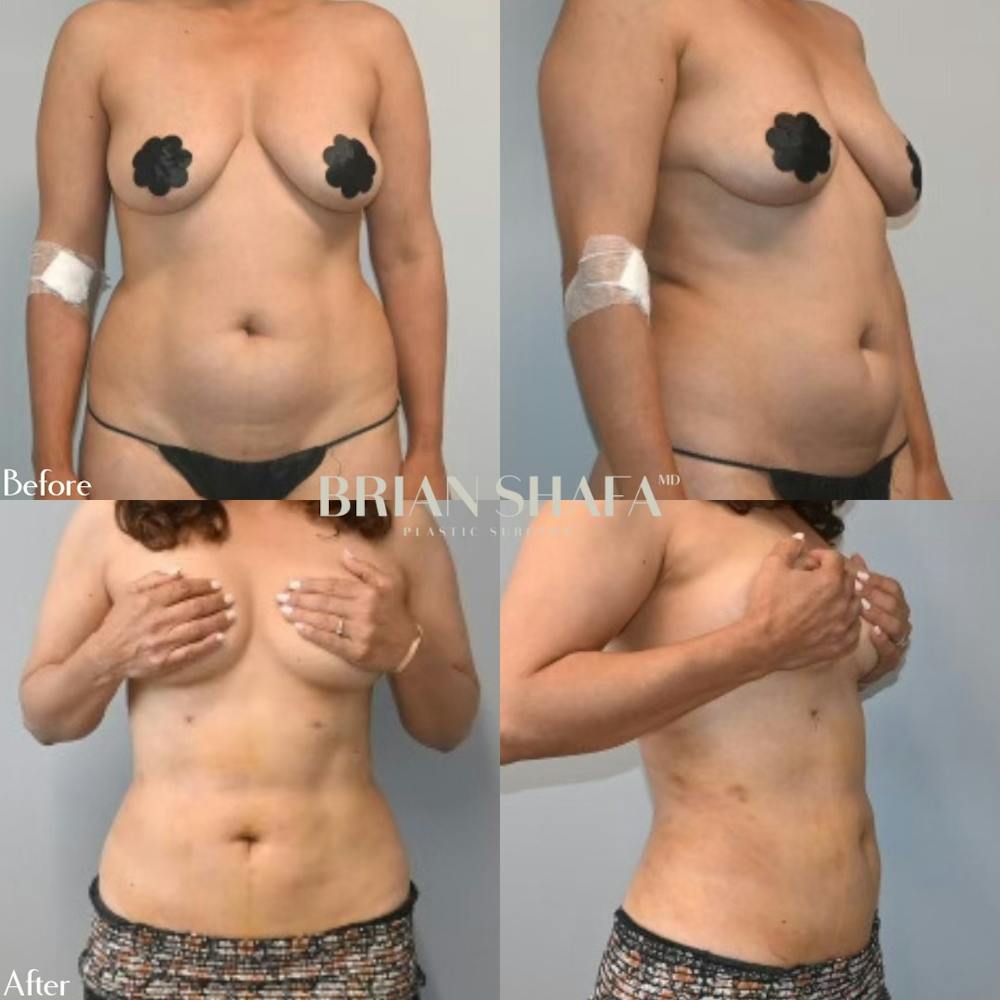 Liposuction Before & After Gallery - Patient 141066809 - Image 1