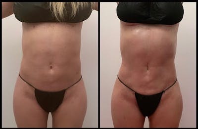 High-Def Liposuction  Before & After Photos - Patient 141066814 - Image 1