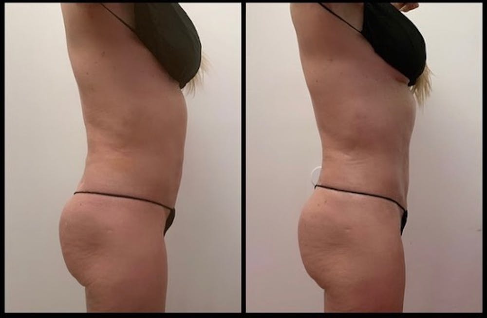 High-Def Liposuction  Before & After Photos - Patient 141066814 - Image 2