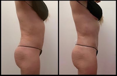 High-Def Liposuction  Before & After Gallery - Patient 141066814 - Image 2
