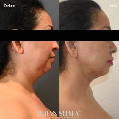 Jawline Contouring  Before & After Photos - Patient 143502720 - Image 1
