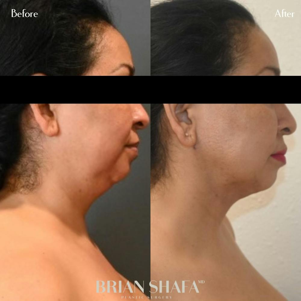 Jawline Contouring  Before & After Gallery - Patient 143502720 - Image 1