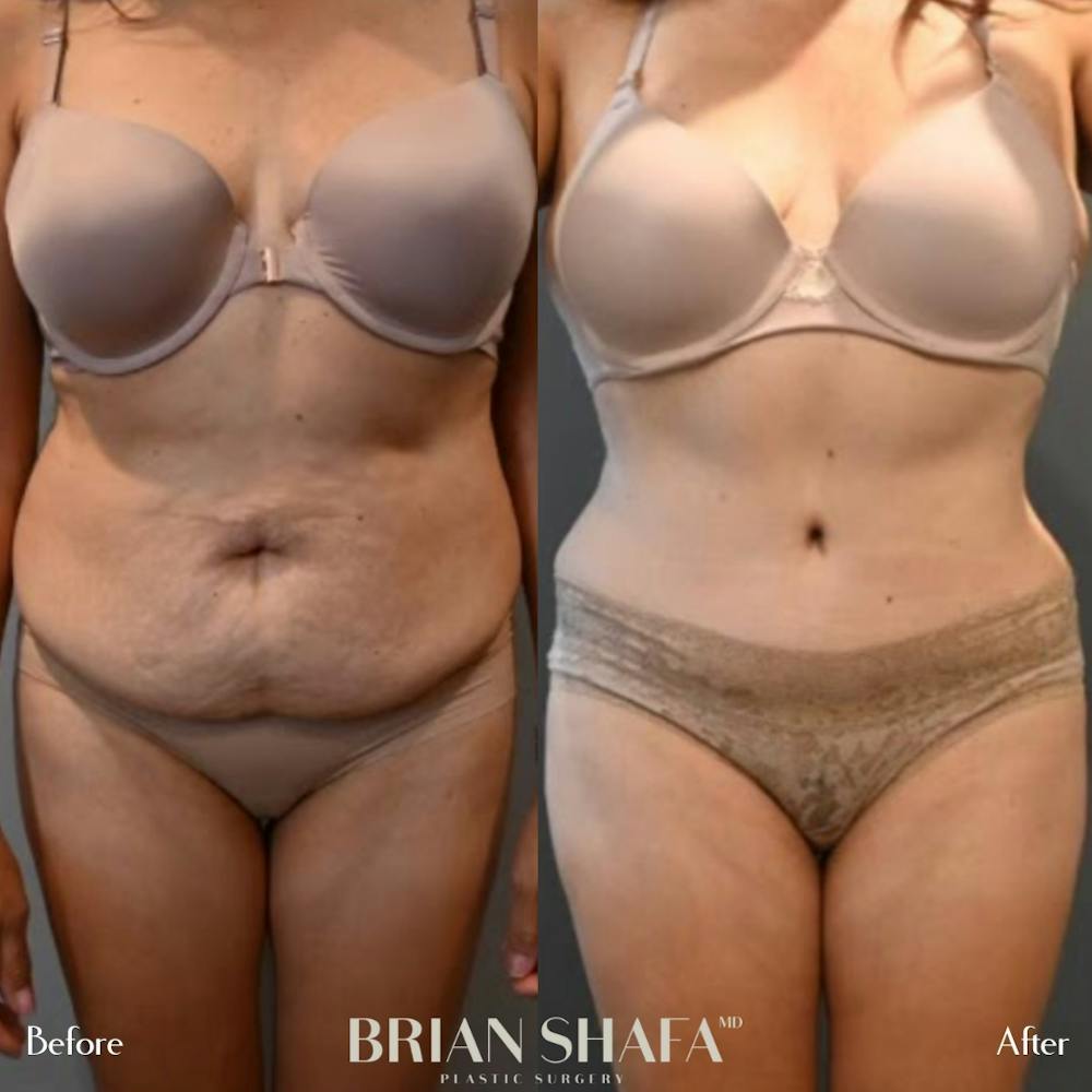 Tummy Tuck/ Abdominoplasty Before & After Gallery - Patient 143502966 - Image 1