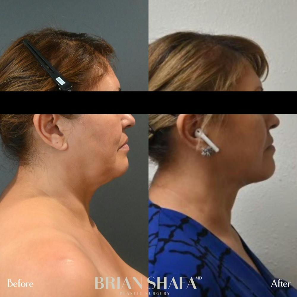 Jawline Contouring  Before & After Gallery - Patient 143502967 - Image 1
