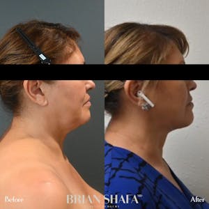 neck liposuction procedure before and after 2
