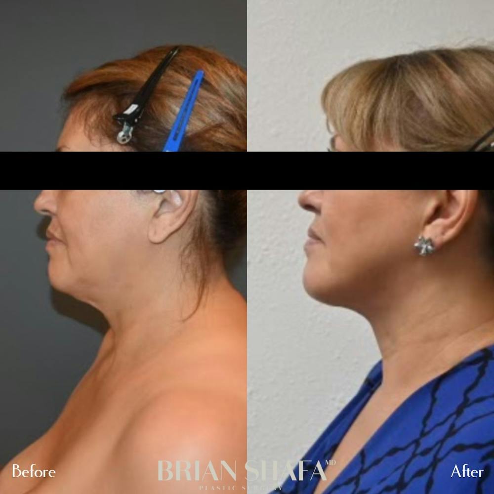 Jawline Contouring  Before & After Photos - Patient 143502967 - Image 2