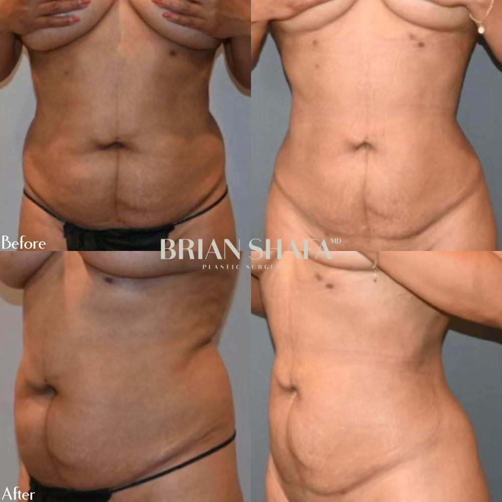Liposuction Before & After Photos - Patient 143502974 - Image 1