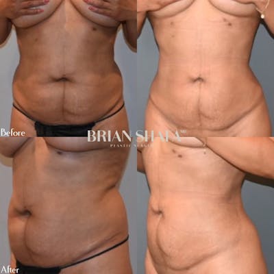 Liposuction Before & After Photos - Patient 143502974 - Image 1