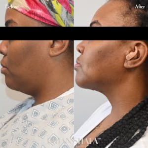 neck liposuction procedure before and after 2