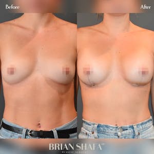 breast augmentation procedure before and after
