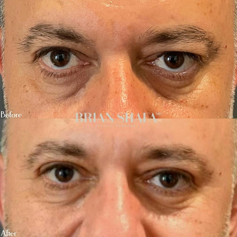 Eyelid Surgery Before & After Photos - Patient 143503000 - Image 1