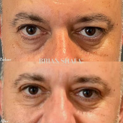 Eyelid Surgery Before & After Photos - Patient 143503000 - Image 1