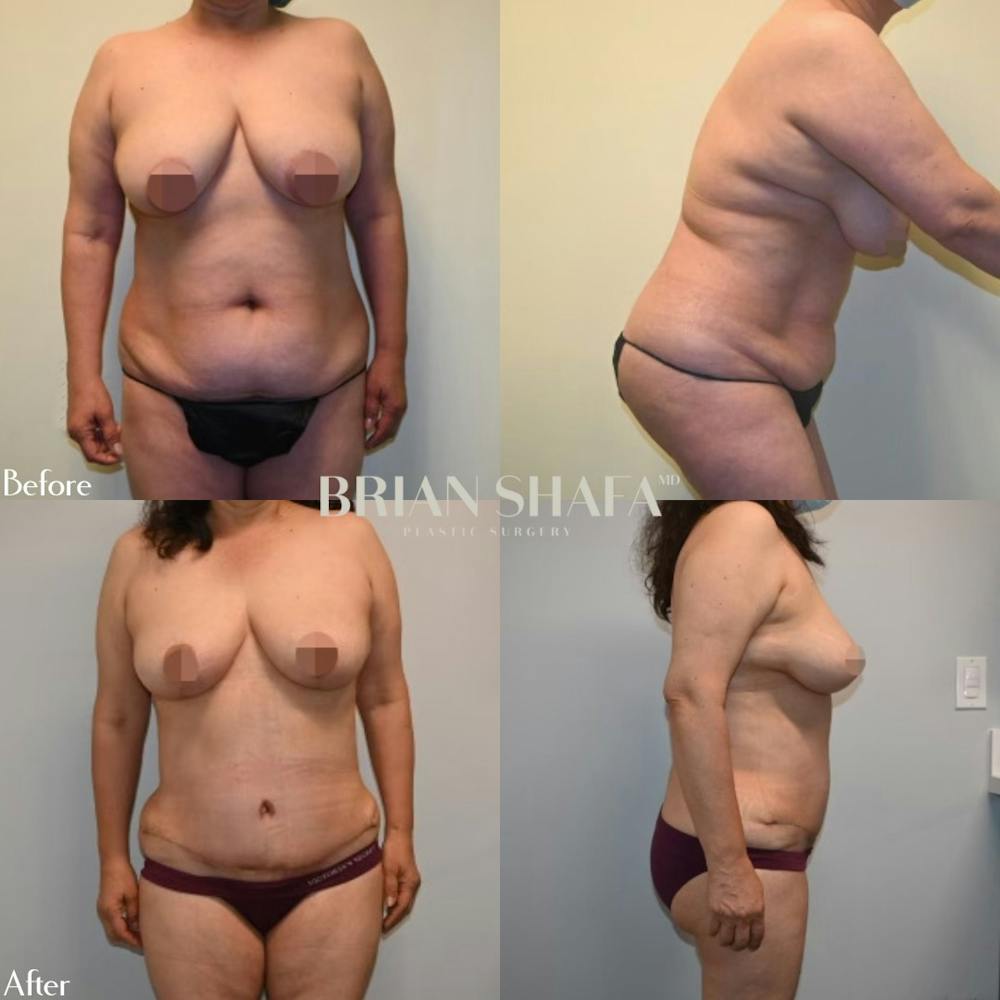 Mommy Makeover Before & After Gallery - Patient 143503023 - Image 1