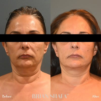 Facelift/Necklift Before & After Photos - Patient 143503076 - Image 1