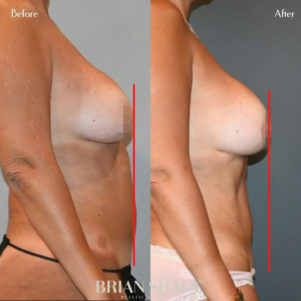 Tummy Tuck (Abdominoplasty) Before & After Photos - Patient 143503298 - Image 1