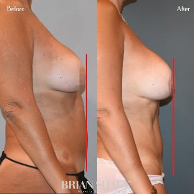 Tummy Tuck/ Abdominoplasty Before & After Gallery - Patient 143503298 - Image 1