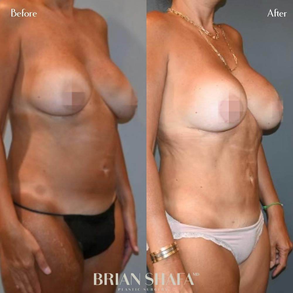Tummy Tuck (Abdominoplasty) Before & After Photos - Patient 143503298 - Image 2
