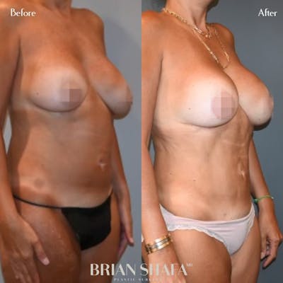 Tummy Tuck (Abdominoplasty) Before & After Photos - Patient 143503298 - Image 2