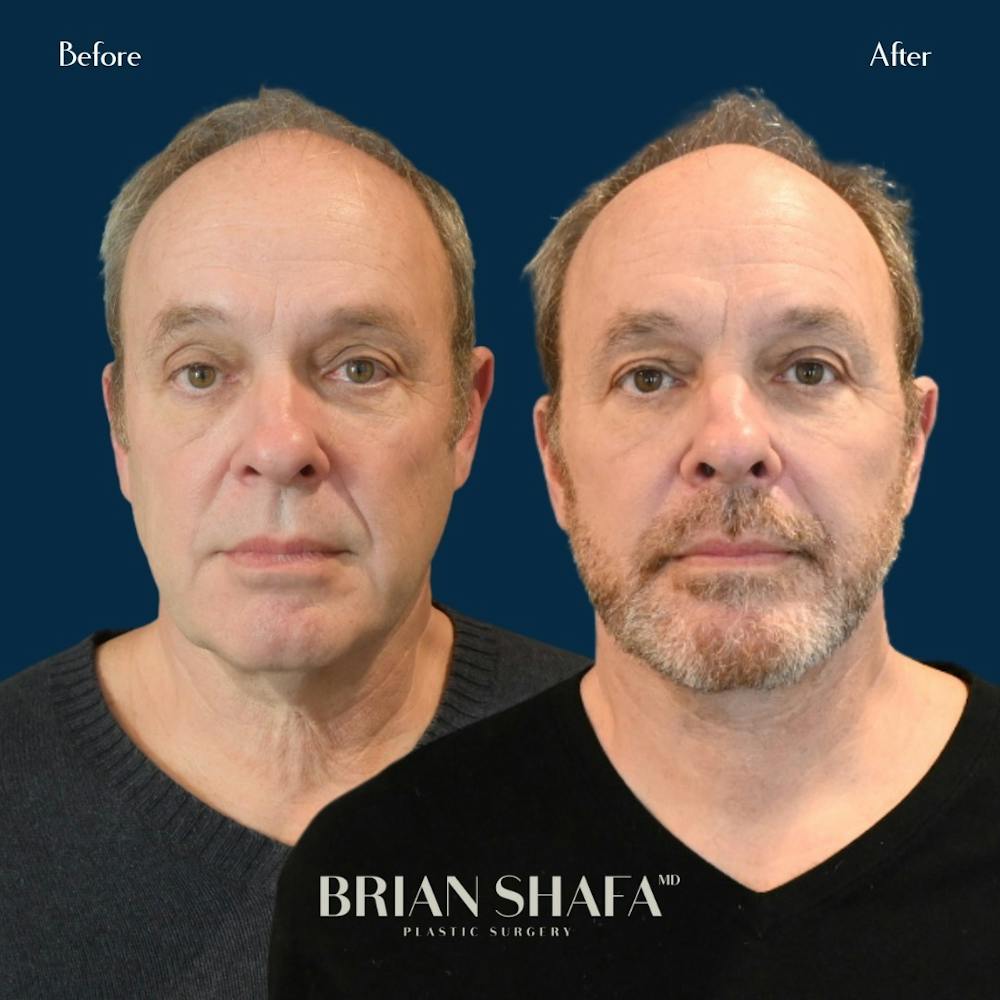 Facelift/Necklift Before & After Gallery - Patient 146286927 - Image 1