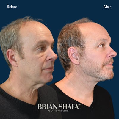 Facelift/Necklift Before & After Gallery - Patient 146286927 - Image 2