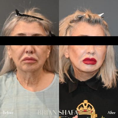 Facelift/Necklift Before & After Gallery - Patient 146287061 - Image 1