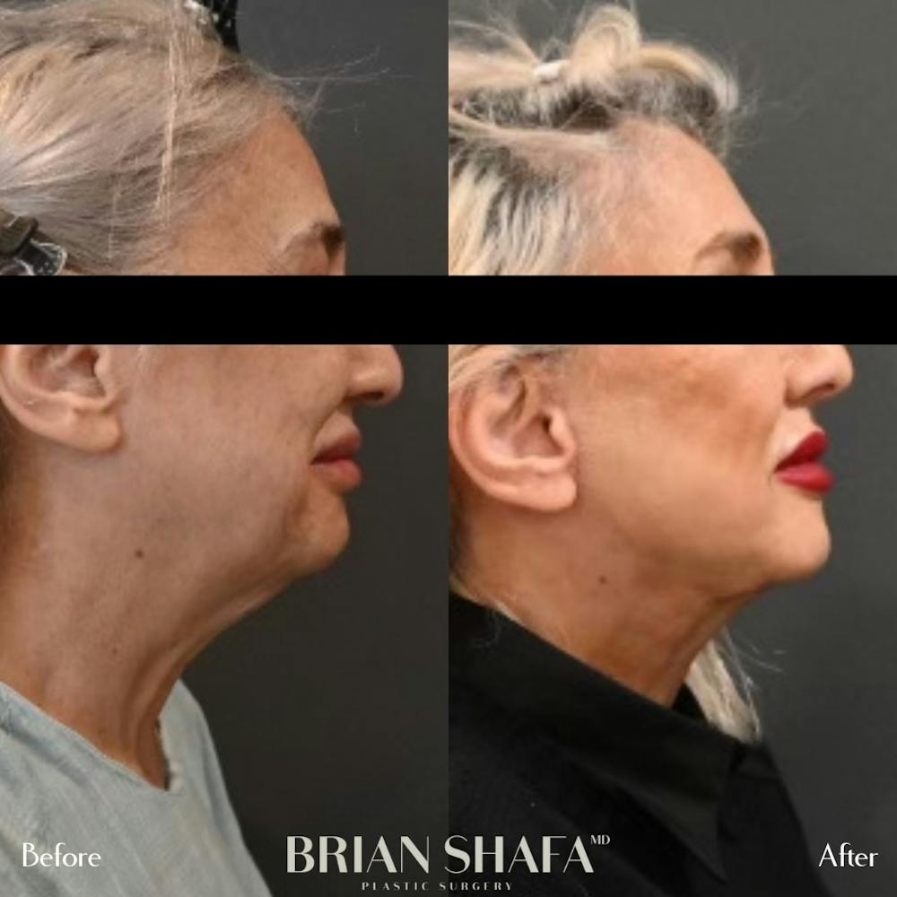 Facelift/Necklift Before & After Gallery - Patient 146287061 - Image 2