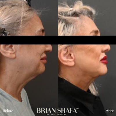 Facelift/Necklift Before & After Photos - Patient 146287061 - Image 2