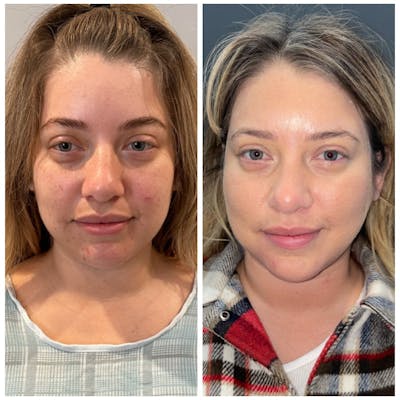 Jawline Contouring  Before & After Photos - Patient 146287064 - Image 1