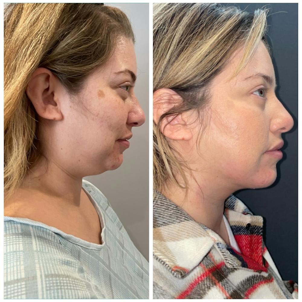 Jawline Contouring  Before & After Photos - Patient 146287064 - Image 2
