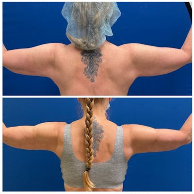 Arm Liposuction Before & After Gallery - Patient 782934 - Image 2