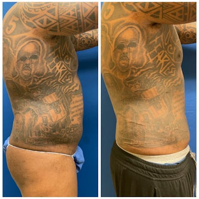 Liposuction Before & After Gallery - Patient 146287088 - Image 1