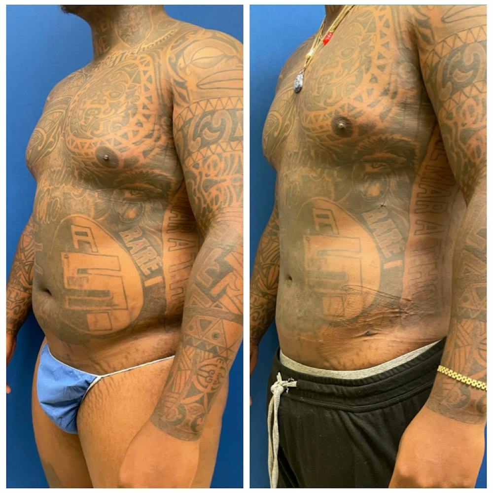Liposuction Before & After Gallery - Patient 146287088 - Image 2