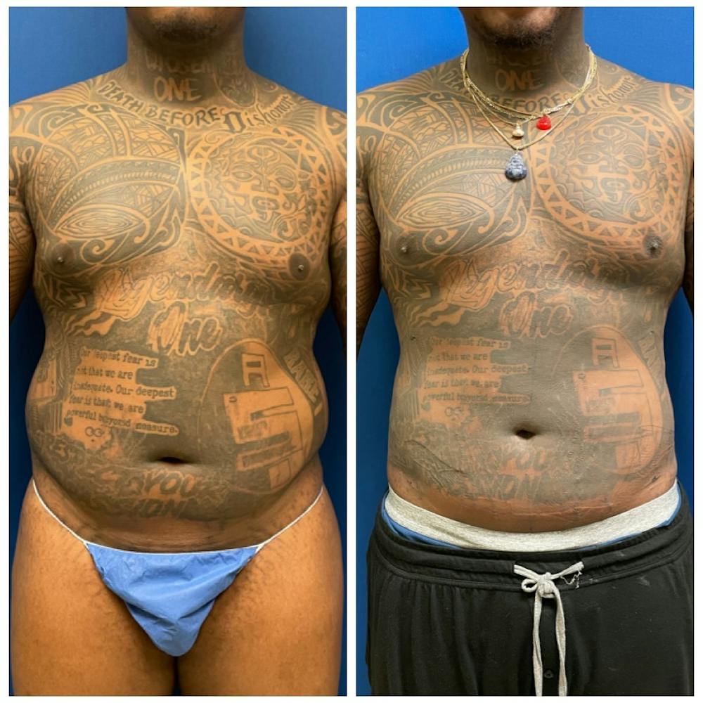 Liposuction Before & After Photos - Patient 146287088 - Image 3
