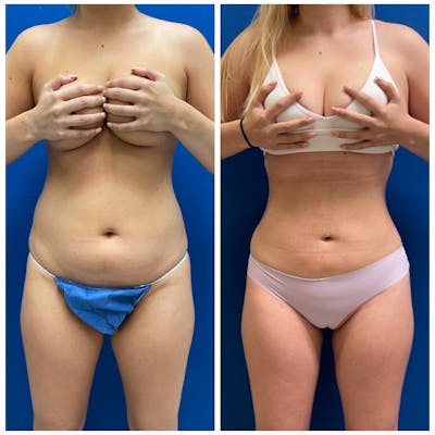 Liposuction Before & After Photos - Patient 146287091 - Image 1