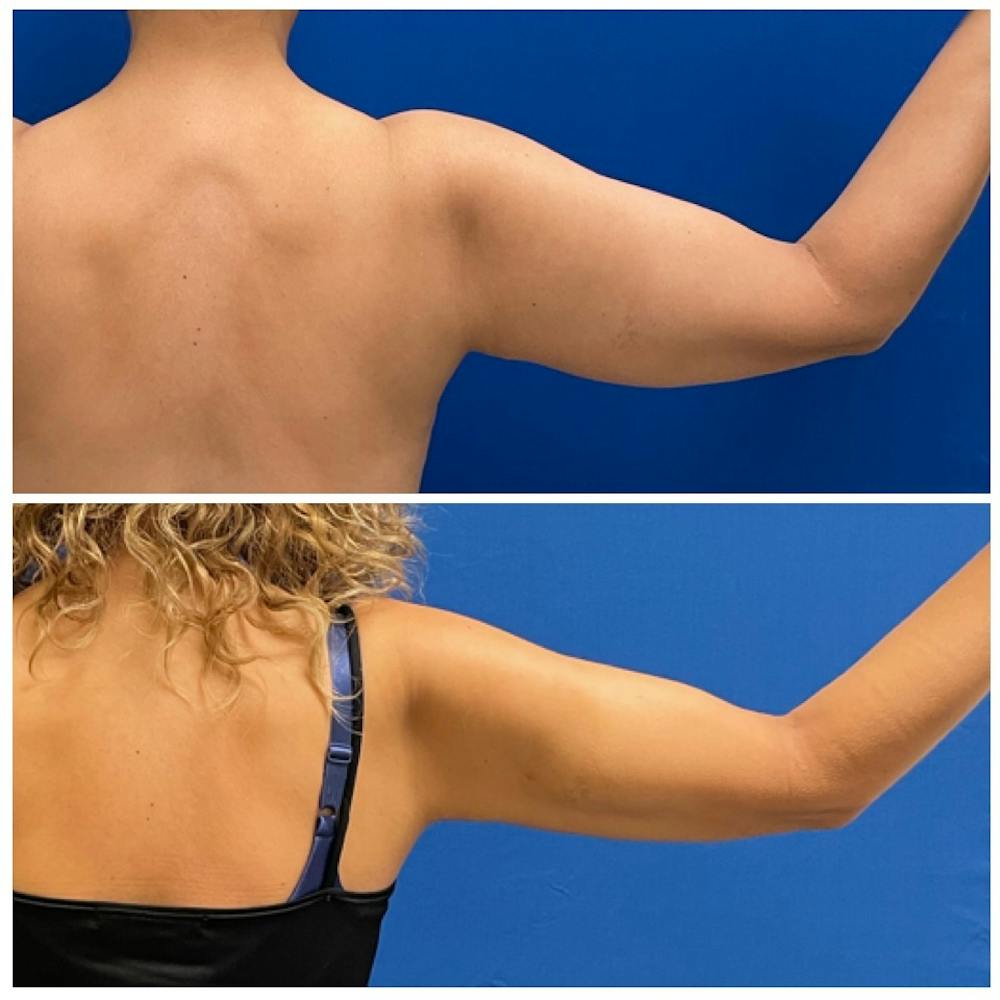 Liposuction Before & After Photos - Patient 146287094 - Image 1