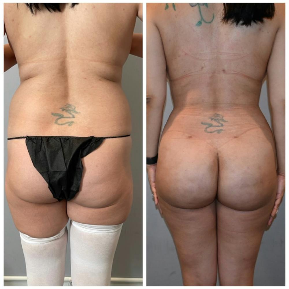 Non-Surgical Sculptra Butt Lift (BBL)  South Florida Center for Cosmetic  Surgery