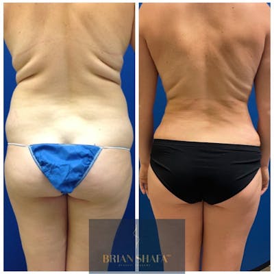 Liposuction Before & After Photos - Patient 146287096 - Image 2