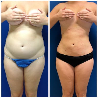 Liposuction Before & After Photos - Patient 146287096 - Image 1