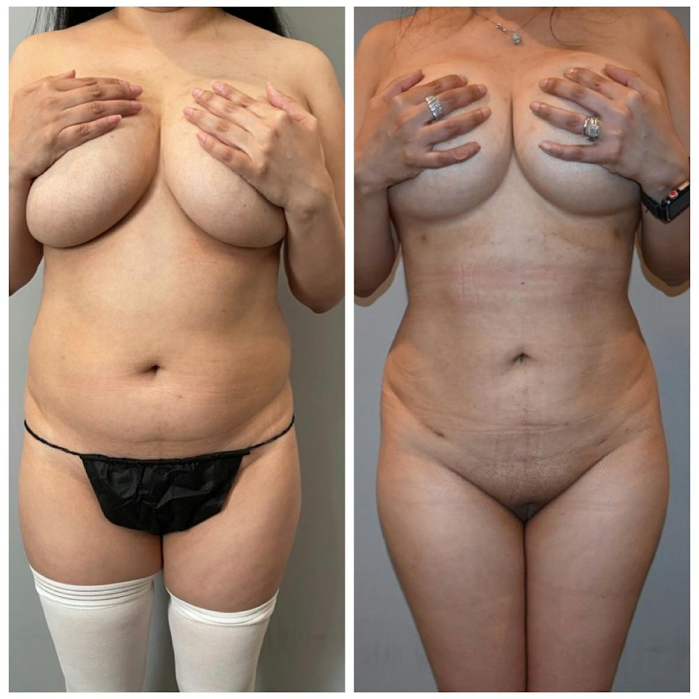 Liposuction Before & After Photos - Patient 146287097 - Image 1