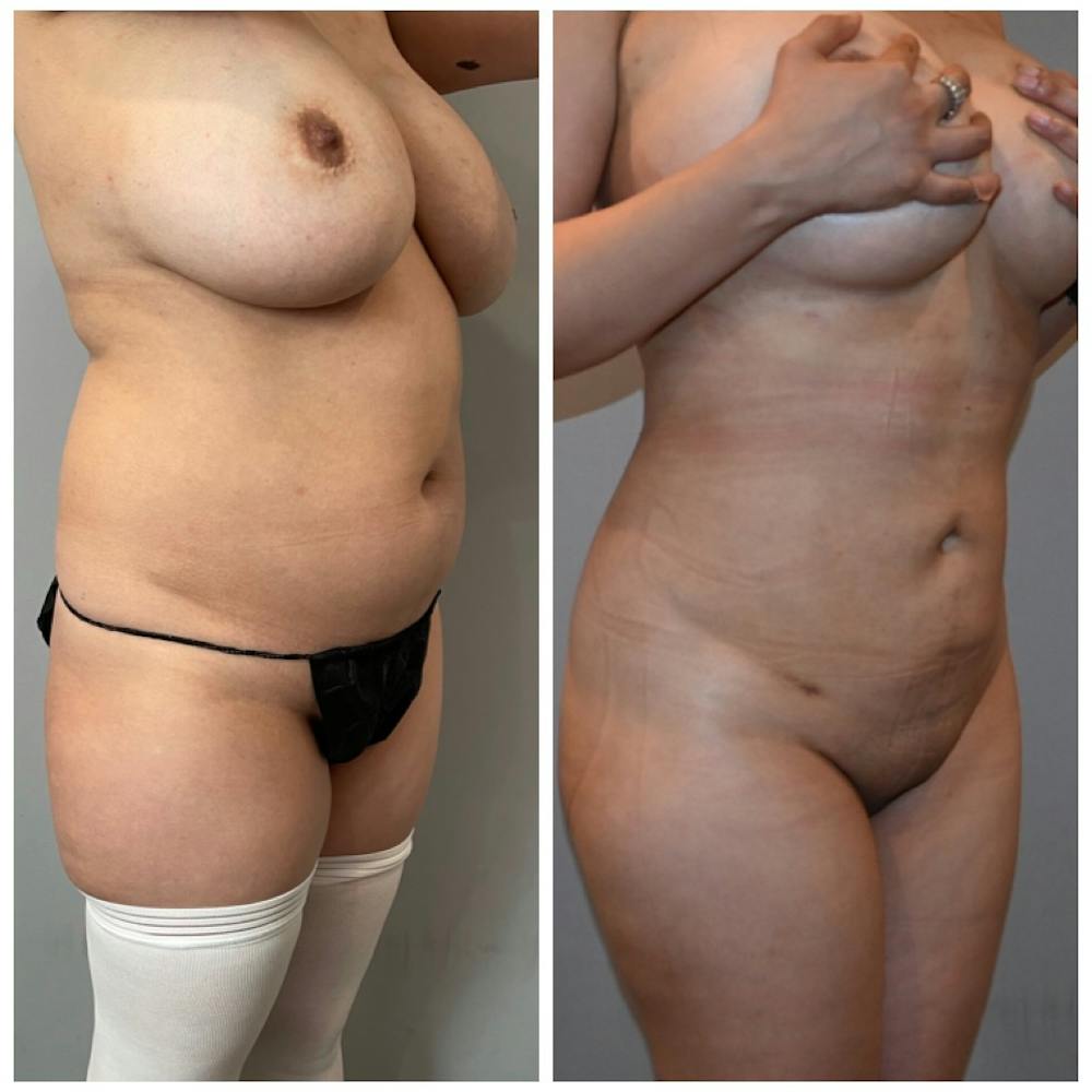 Liposuction Before & After Photos - Patient 146287097 - Image 2