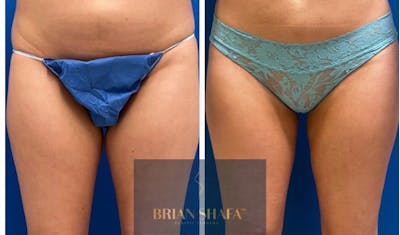 Liposuction Before & After Photos - Patient 146287098 - Image 1