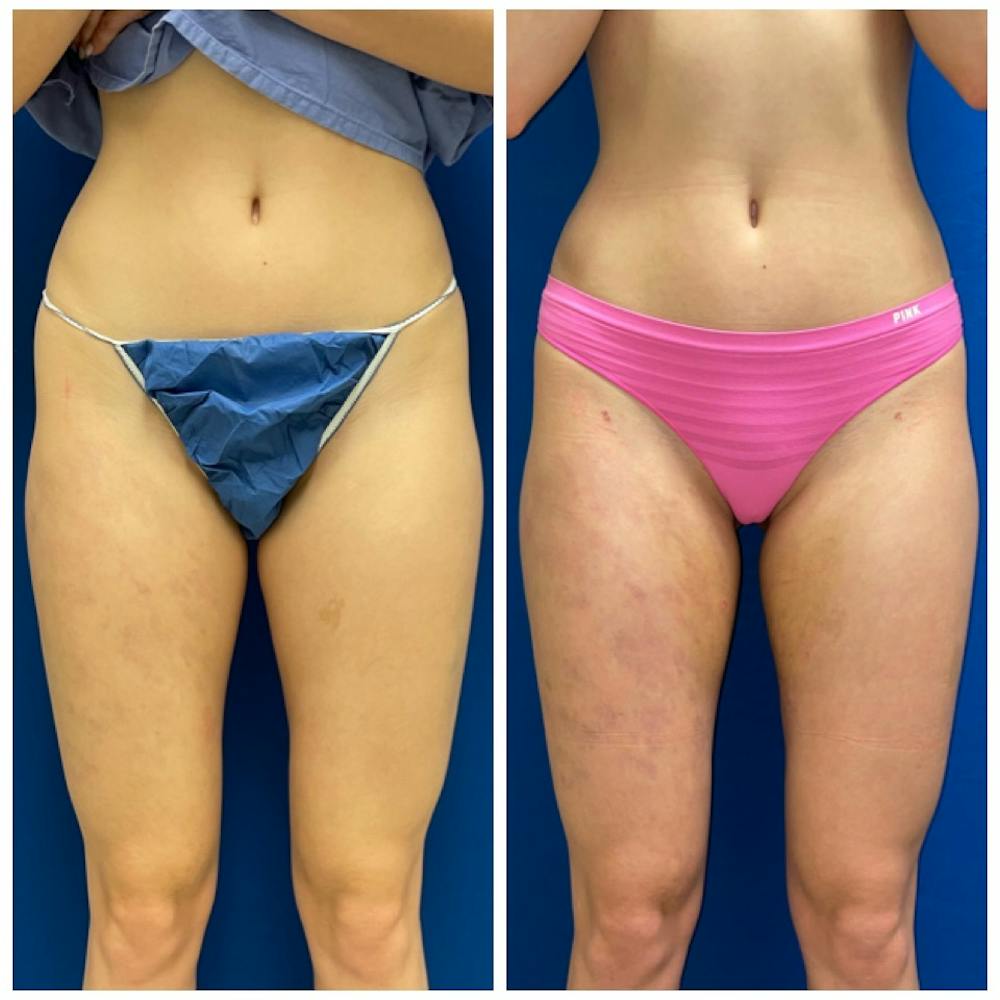 Liposuction Before & After Photos - Patient 146287101 - Image 1