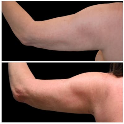 Arm Liposuction Before & After Photos - Patient 316413 - Image 1