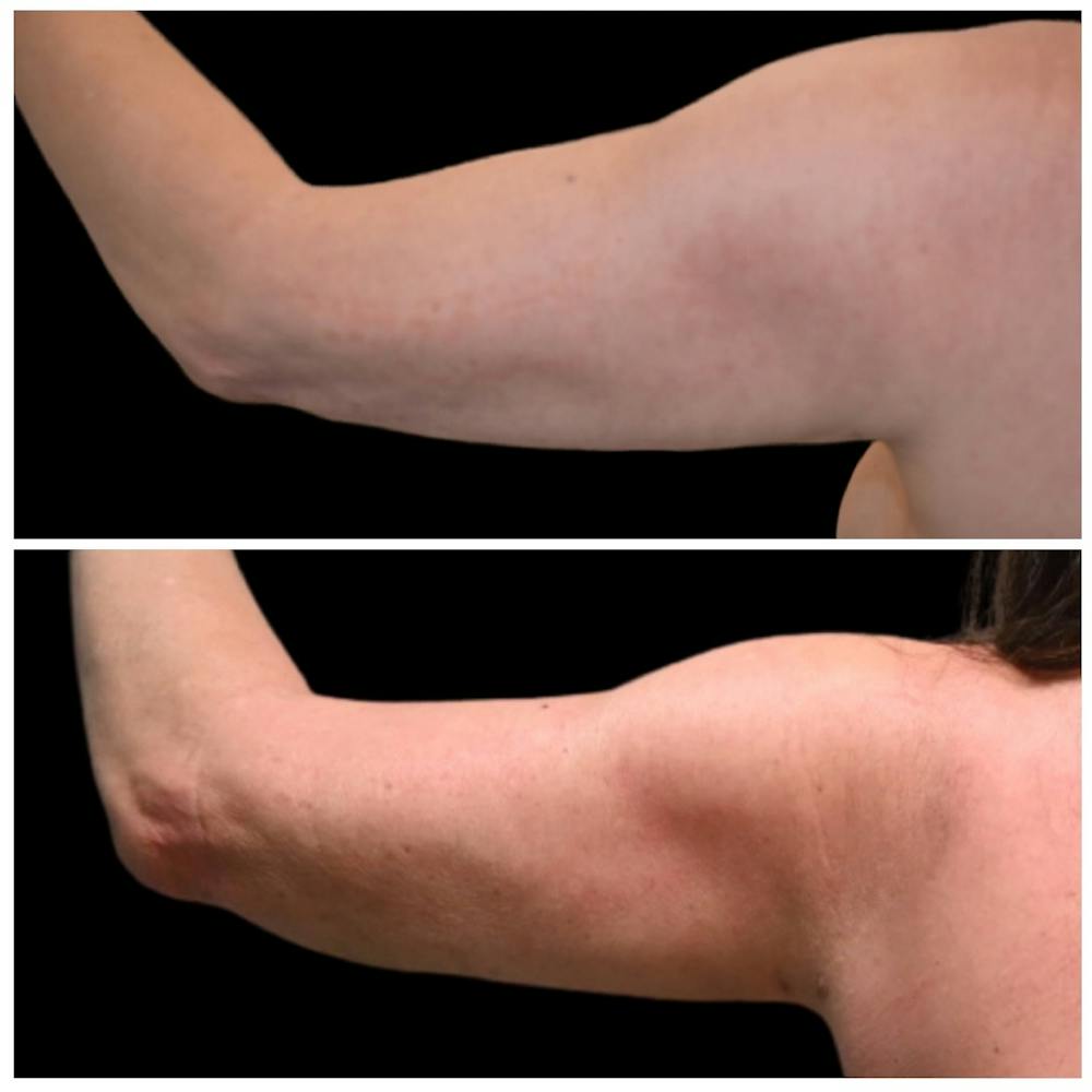 Arm Liposuction Before & After Photos - Patient 316413 - Image 1