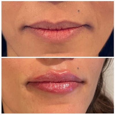Lip Fillers Before & After Photos - Patient 146287119 - Image 1
