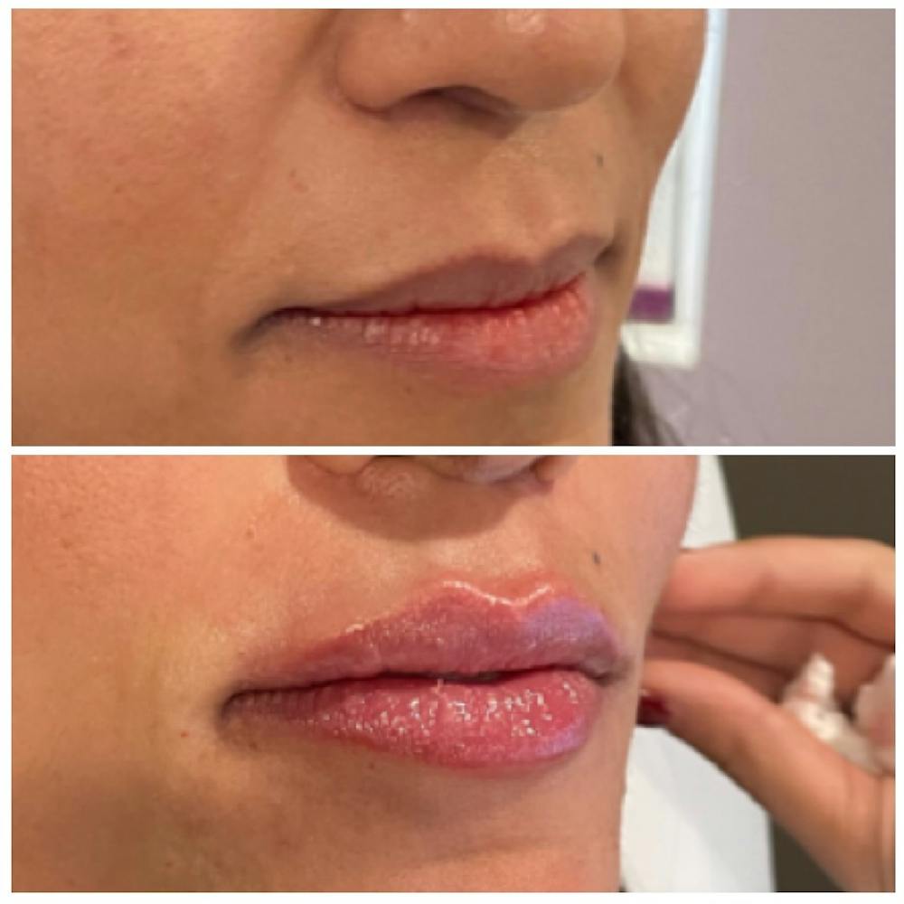 Lip Fillers Before & After Gallery - Patient 146287119 - Image 2